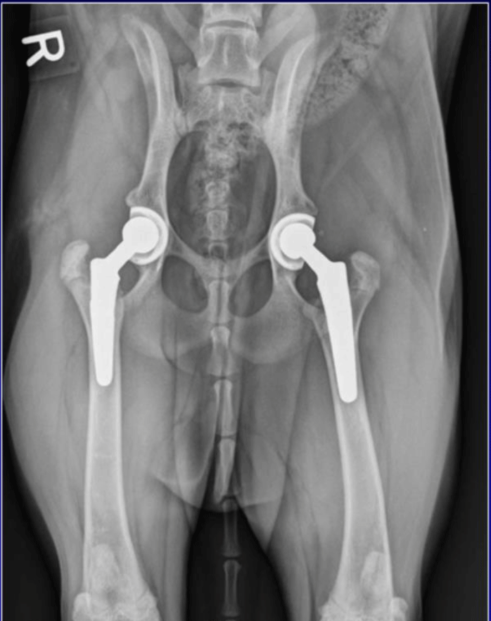 Postoperative Bilateral Total Hip Replacement Radiograph